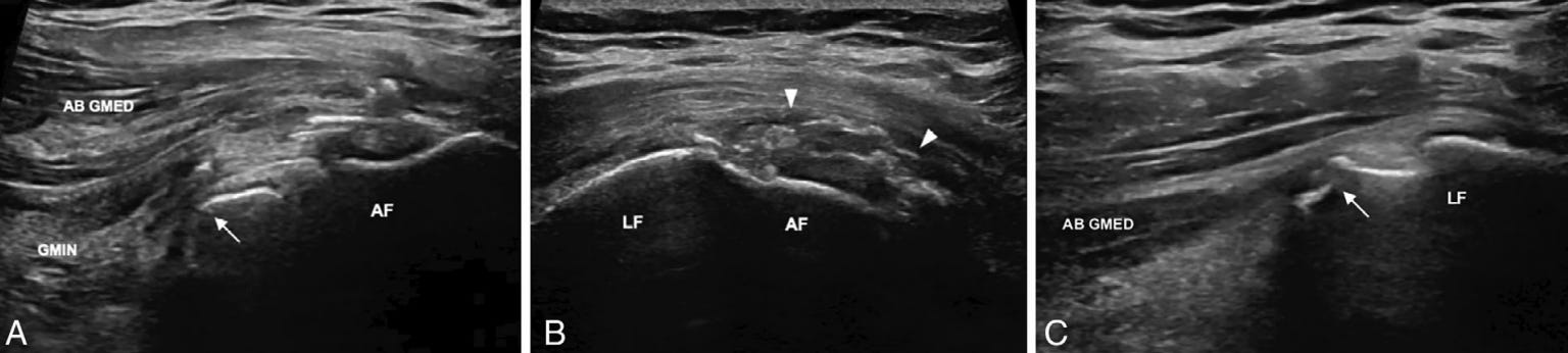 Gluteo menor 5 ecografia tempo formacion.jpg